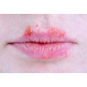 Herpes - suplimente naturale (tratament)